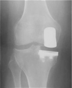 AFTER - Following Outpatient Unicompartmental Arthroplasty